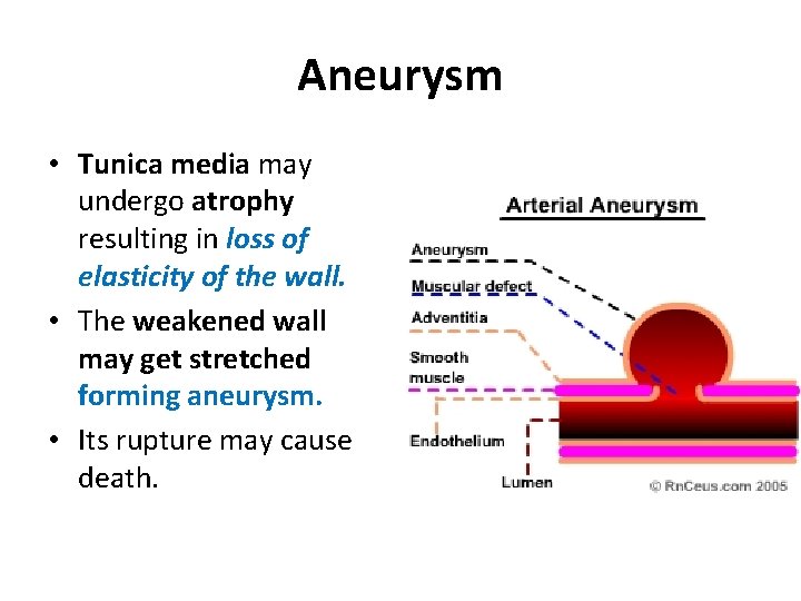 Aneurysm • Tunica media may undergo atrophy resulting in loss of elasticity of the