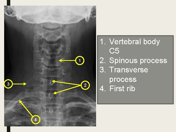 1 3 2 4 1. Vertebral body C 5 2. Spinous process 3. Transverse