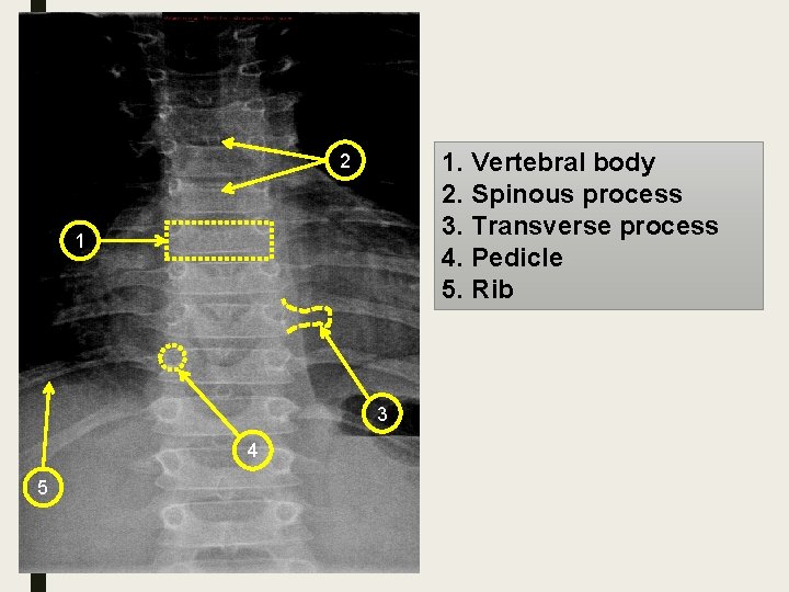 1. Vertebral body 2. Spinous process 3. Transverse process 4. Pedicle 5. Rib 2