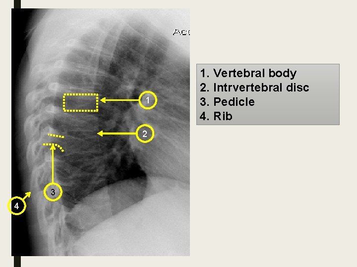 1 2 3 4 1. Vertebral body 2. Intrvertebral disc 3. Pedicle 4. Rib