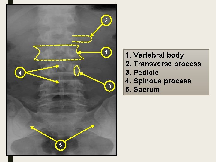 2 1 4 3 5 1. Vertebral body 2. Transverse process 3. Pedicle 4.