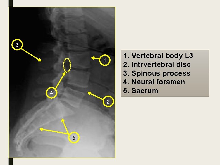 3 1. Vertebral body L 3 2. Intrvertebral disc 3. Spinous process 4. Neural