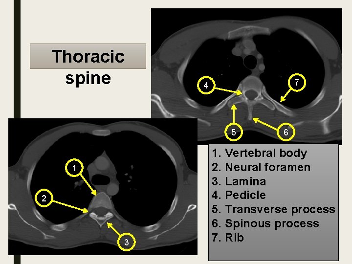 Thoracic spine 7 4 5 1 2 3 6 1. Vertebral body 2. Neural