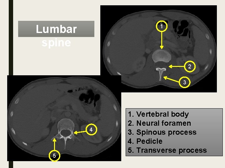 Lumbar spine 1 2 3 4 5 1. Vertebral body 2. Neural foramen 3.