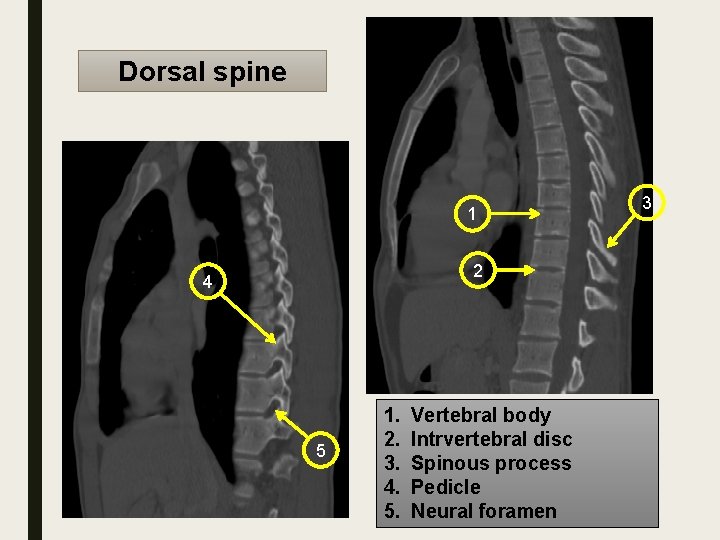 Dorsal spine 1 2 4 5 1. 2. 3. 4. 5. Vertebral body Intrvertebral