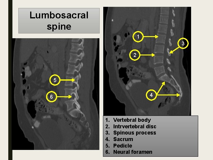 Lumbosacral spine 1 3 2 5 4 6 1. 2. 3. 4. 5. 6.