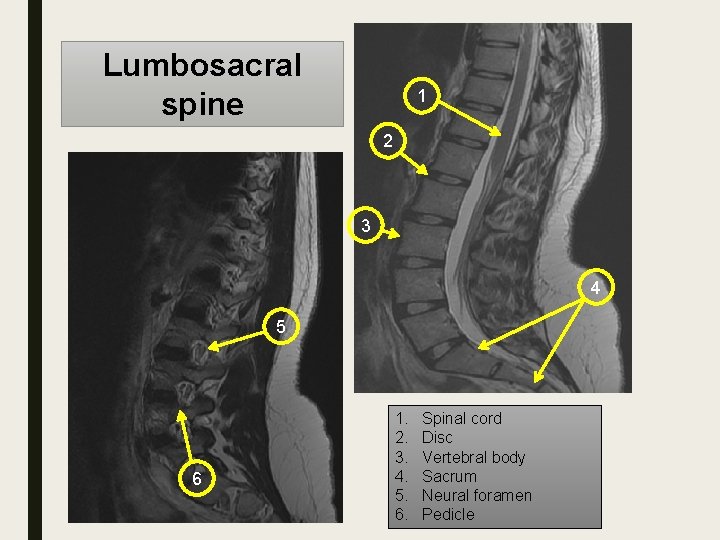 Lumbosacral spine 1 2 3 4 5 6 1. 2. 3. 4. 5. 6.