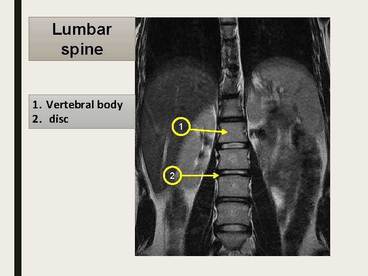 Lumbar spine 1. Vertebral body 2. disc 1 2 