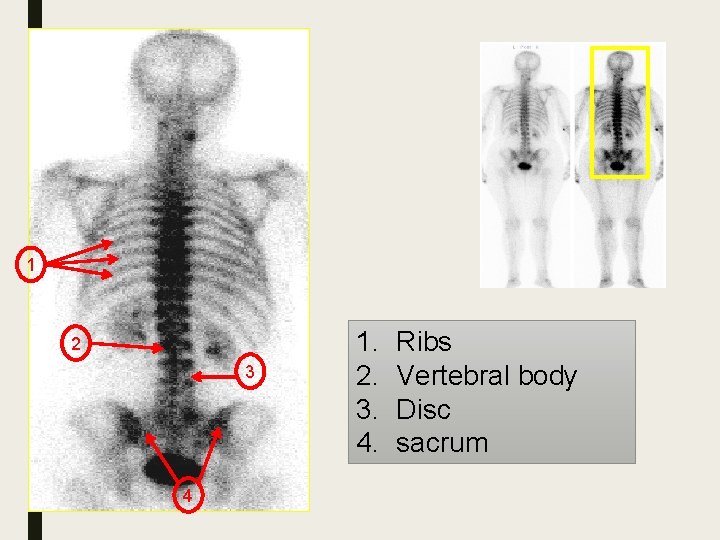 1 2 3 4 1. 2. 3. 4. Ribs Vertebral body Disc sacrum 