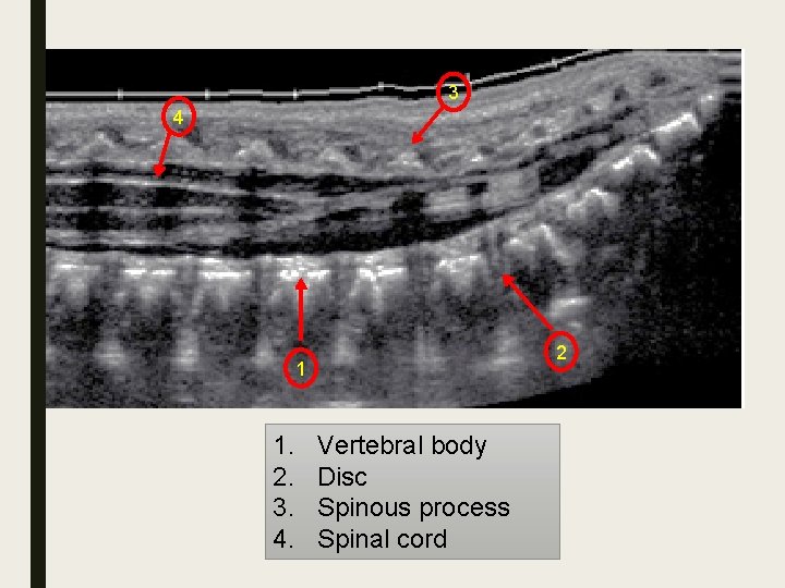 3 4 2 1 1. 2. 3. 4. Vertebral body Disc Spinous process Spinal