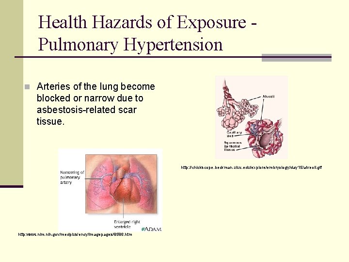 Health Hazards of Exposure Pulmonary Hypertension n Arteries of the lung become blocked or