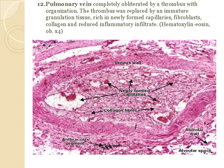 12. Pulmonary vein completely obliterated by a thrombus with organization. The thrombus was replaced