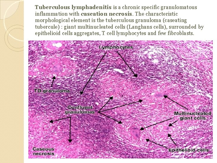 Tuberculous lymphadenitis is a chronic specific granulomatous inflammation with caseation necrosis. The characteristic morphological