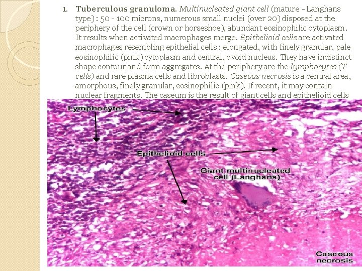 1. Tuberculous granuloma. Multinucleated giant cell (mature - Langhans type) : 50 - 100