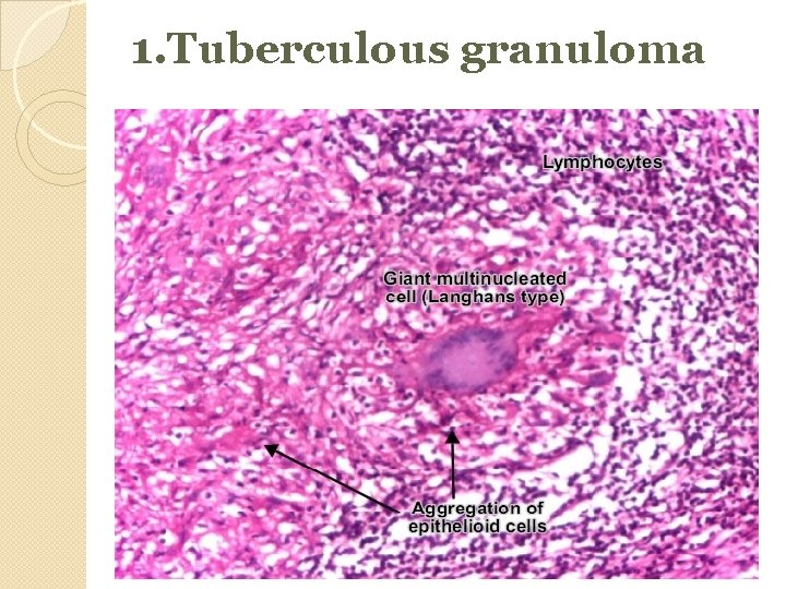 1. Tuberculous granuloma 