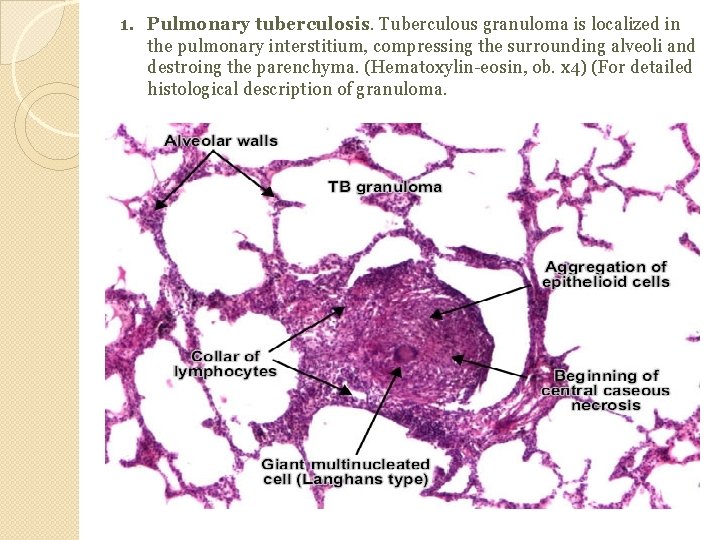 1. Pulmonary tuberculosis. Tuberculous granuloma is localized in the pulmonary interstitium, compressing the surrounding