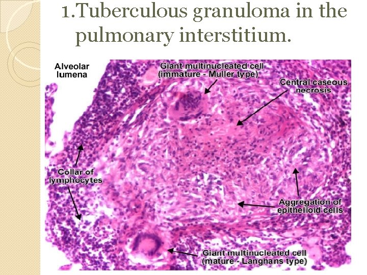 1. Tuberculous granuloma in the pulmonary interstitium. 