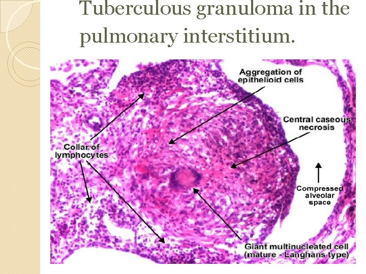 Tuberculous granuloma in the pulmonary interstitium. 