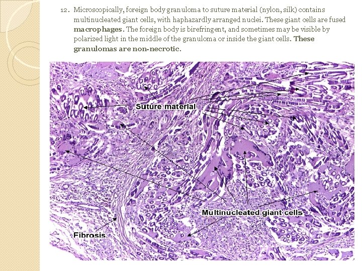 12. Microscopically, foreign body granuloma to suture material (nylon, silk) contains multinucleated giant cells,
