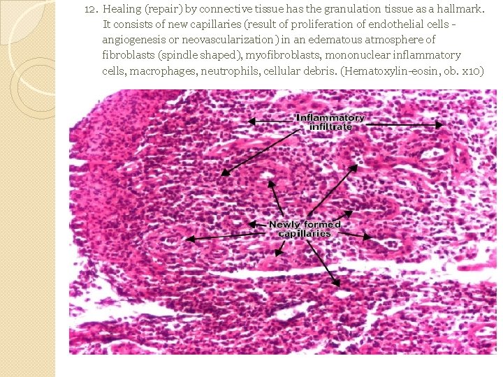 12. Healing (repair) by connective tissue has the granulation tissue as a hallmark. It