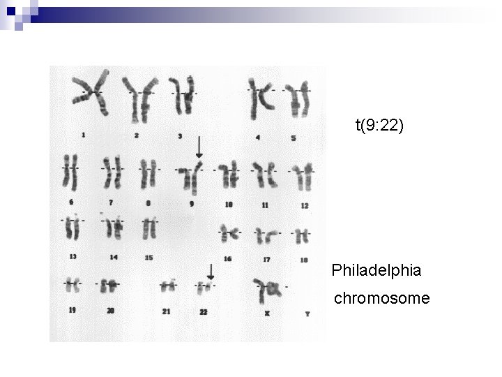 t(9: 22) Philadelphia chromosome 