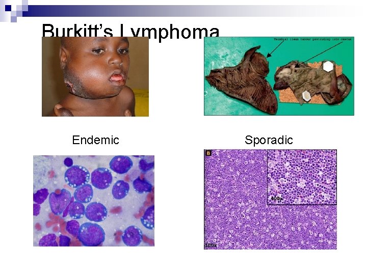 Burkitt’s Lymphoma Endemic Sporadic 