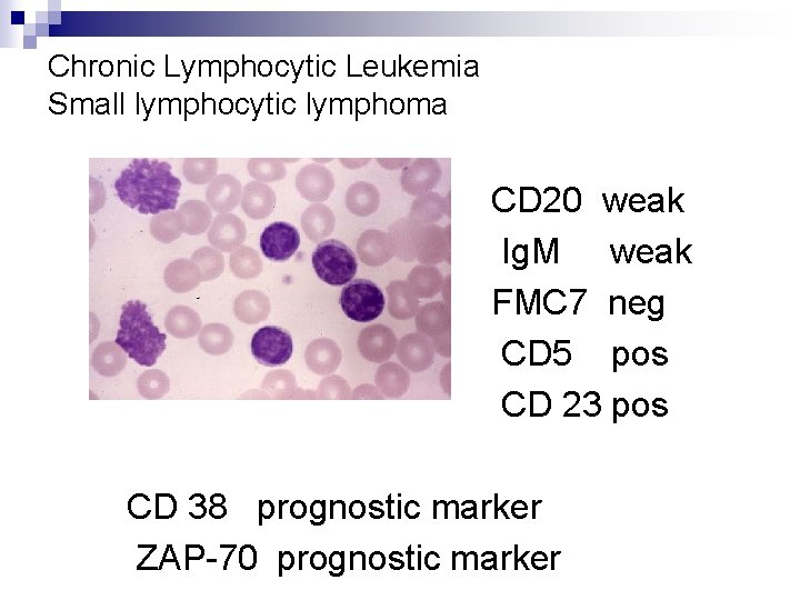 Chronic Lymphocytic Leukemia Small lymphocytic lymphoma CD 20 weak Ig. M weak FMC 7