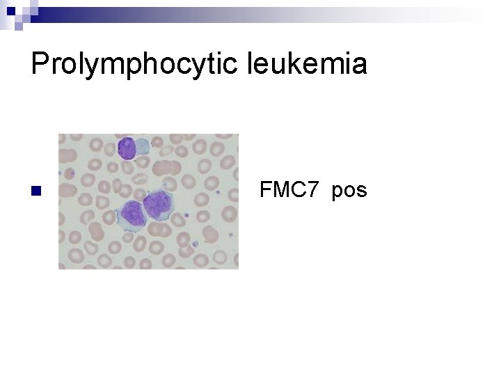 Prolymphocytic leukemia n FMC 7 pos 
