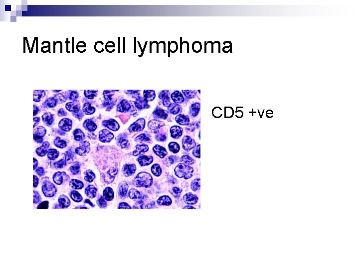 Mantle cell lymphoma CD 5 +ve 