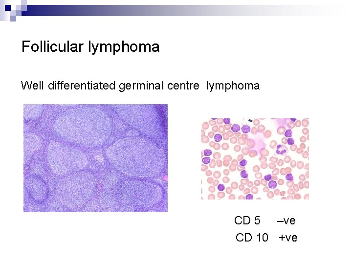 Follicular lymphoma Wel. I differentiated germinal centre lymphoma CD 5 –ve CD 10 +ve