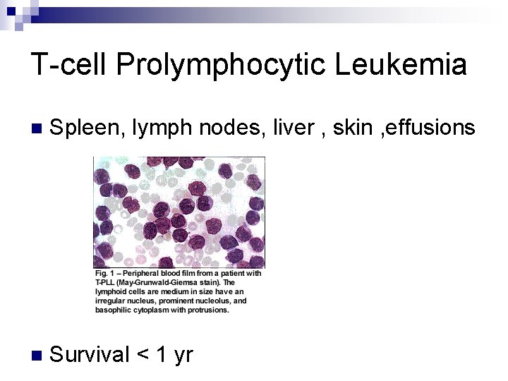 T-cell Prolymphocytic Leukemia n Spleen, lymph nodes, liver , skin , effusions n Survival