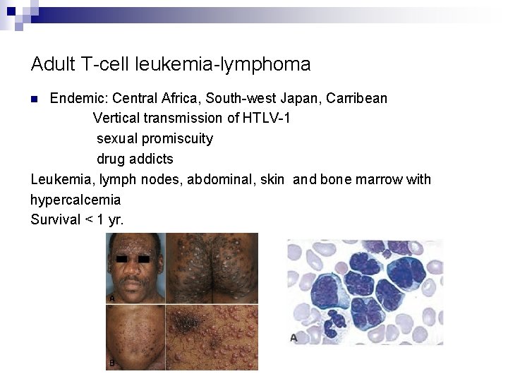 Adult T-cell leukemia-lymphoma Endemic: Central Africa, South-west Japan, Carribean Vertical transmission of HTLV-1 sexual