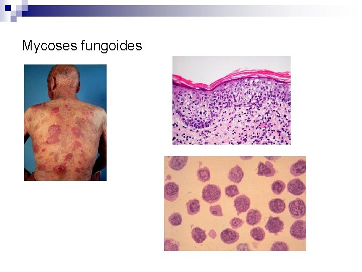 Mycoses fungoides 