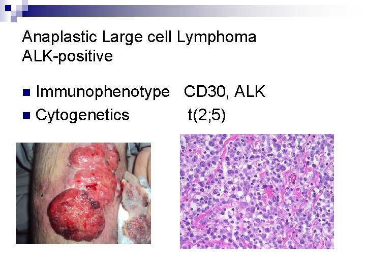 Anaplastic Large cell Lymphoma ALK-positive Immunophenotype CD 30, ALK n Cytogenetics t(2; 5) n