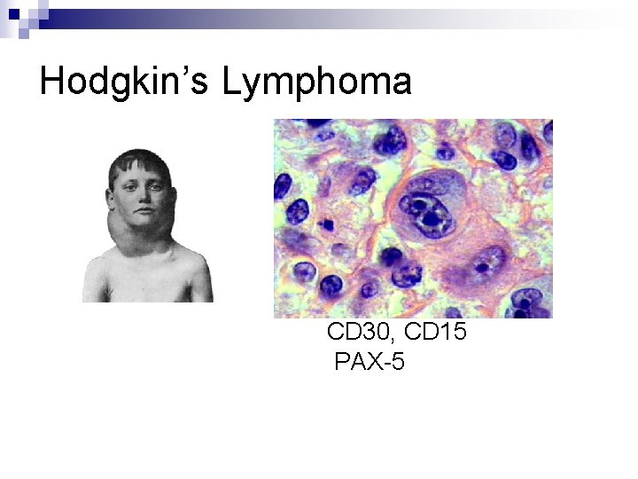 Hodgkin’s Lymphoma CD 30, CD 15 PAX-5 