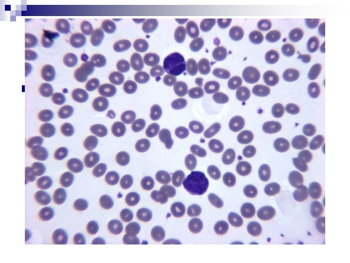 n AH. From Kaitaia Long standing CLL. Blood film changes 