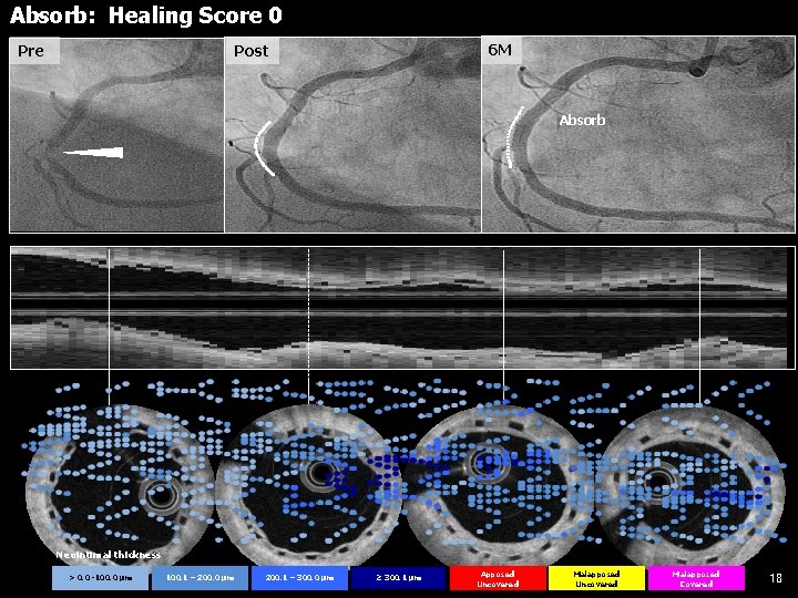 Absorb: Healing Score 0 6 M Post Pre Absorb Neointimal thickness > 0. 0
