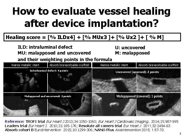 How to evaluate vessel healing after device implantation? Healing score = [% ILDx 4]
