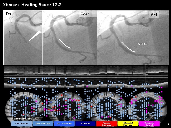 Xience: Healing Score 12. 2 Pre Post 6 M Xience Neointimal thickness > 0.