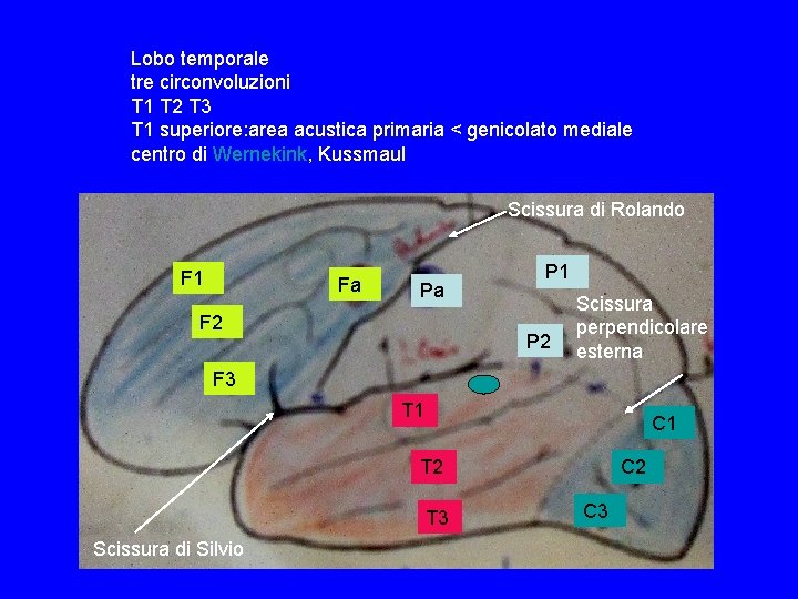 Lobo temporale tre circonvoluzioni T 1 T 2 T 3 T 1 superiore: area