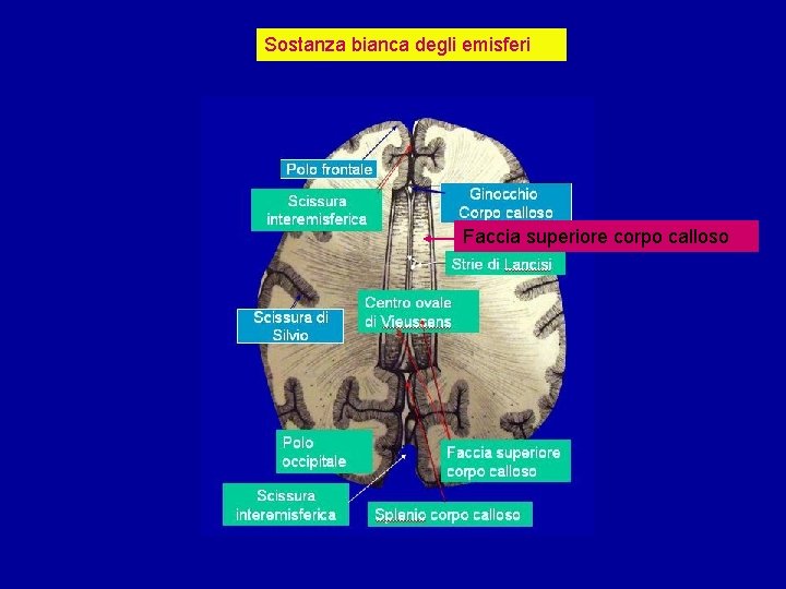 Sostanza bianca degli emisferi Faccia superiore corpo calloso 