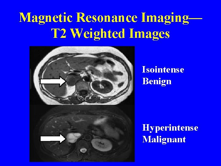 Magnetic Resonance Imaging— T 2 Weighted Images Isointense Benign Hyperintense Malignant 