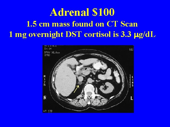 Adrenal $100 1. 5 cm mass found on CT Scan 1 mg overnight DST