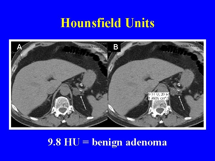 Hounsfield Units 9. 8 HU = benign adenoma 
