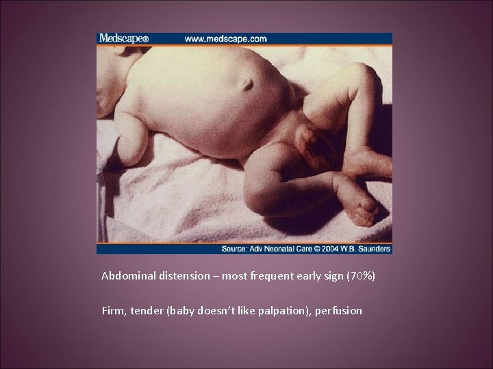 Abdominal distension – most frequent early sign (70%) Firm, tender (baby doesn’t like palpation),