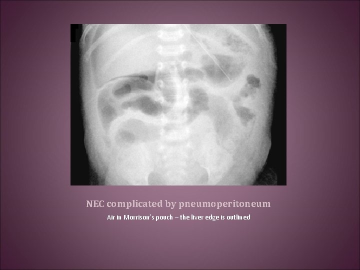 NEC complicated by pneumoperitoneum Air in Morrison’s pouch – the liver edge is outlined