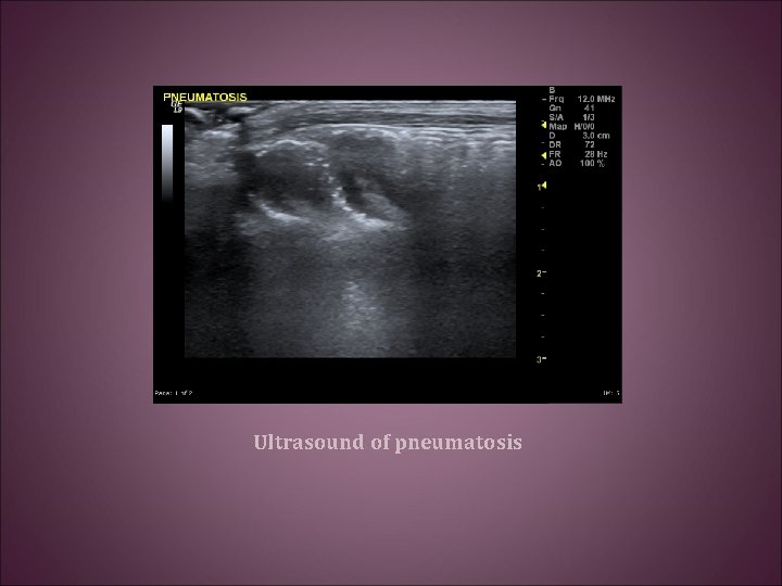 Ultrasound of pneumatosis 