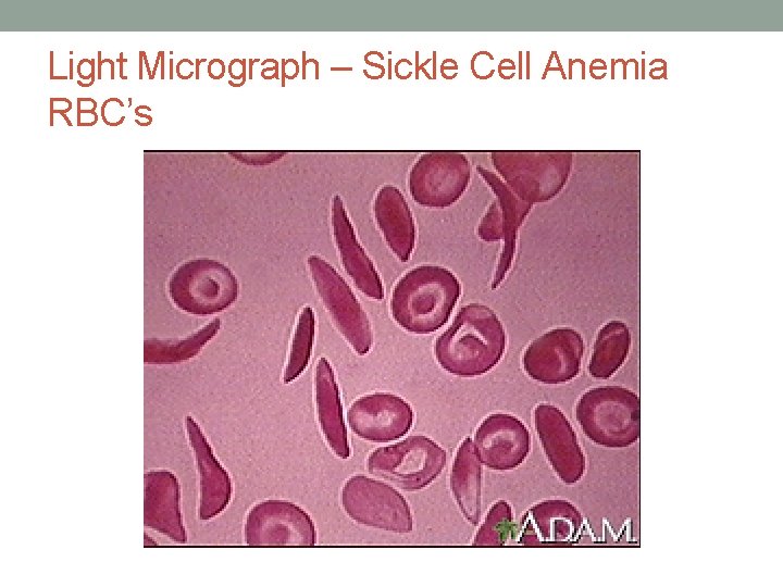 Light Micrograph – Sickle Cell Anemia RBC’s 