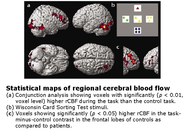 Statistical maps of regional cerebral blood flow (a) Conjunction analysis showing voxels with significantly