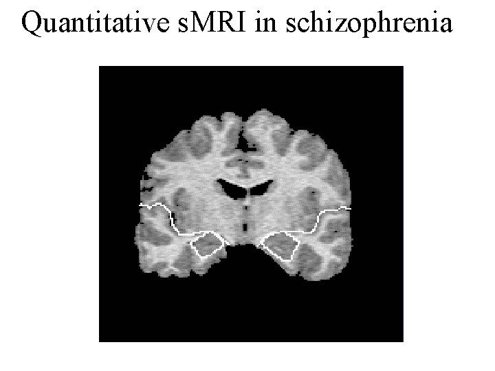 Quantitative s. MRI in schizophrenia 